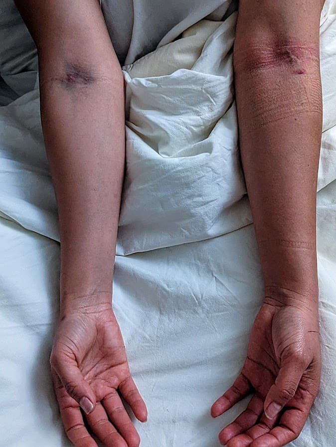 Needles and tubes bruise my arms. A stark reminder of survival.