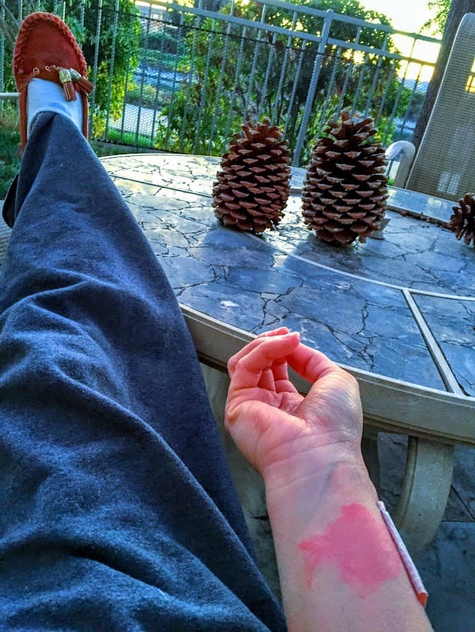 Rashes appear randomly, especially on my forearms, a daily reminder of how relentless lupus is.